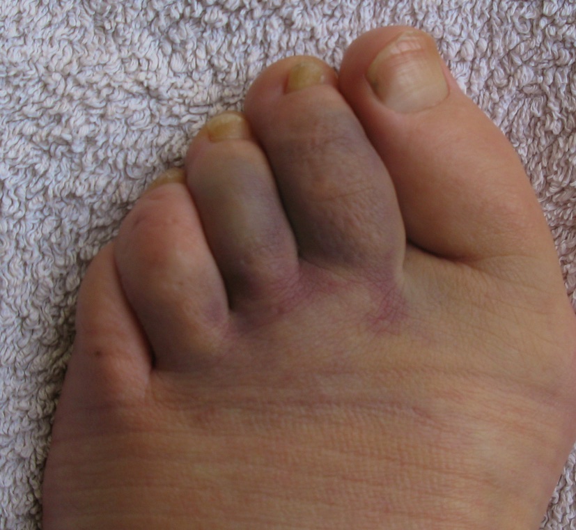 Bruised foot (1).jpg